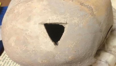 تركيا.. اكتشاف جمجمة مثقوبة عمرها 3200 عام