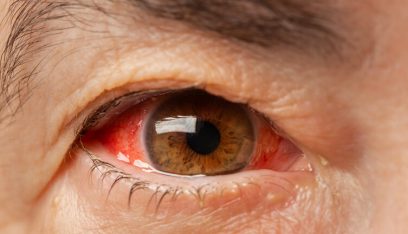 وباء العين الوردية يجتاح أجزاء من آسيا ويصيب الآلاف يومياً