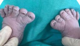 طفل بـ 12 أصبعاً في قدميه!