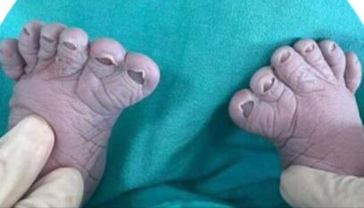 طفل بـ 12 اصبعاً في قدميه!
