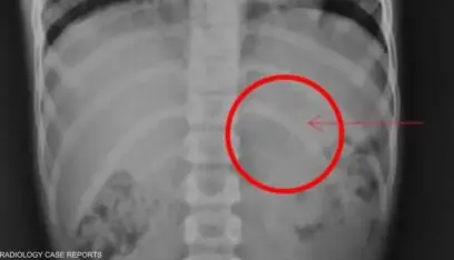 الأشعة تكشف “مفاجأة صادمة” في بطن طفل.. كيف نجا؟